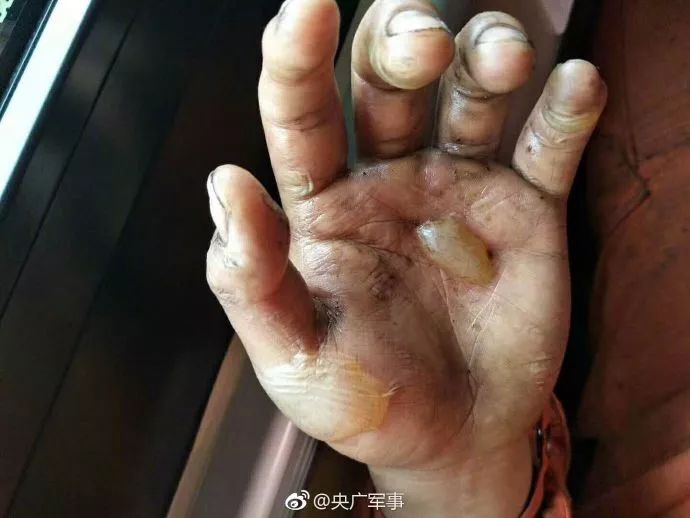 抗疫医护人员受伤的手图片
