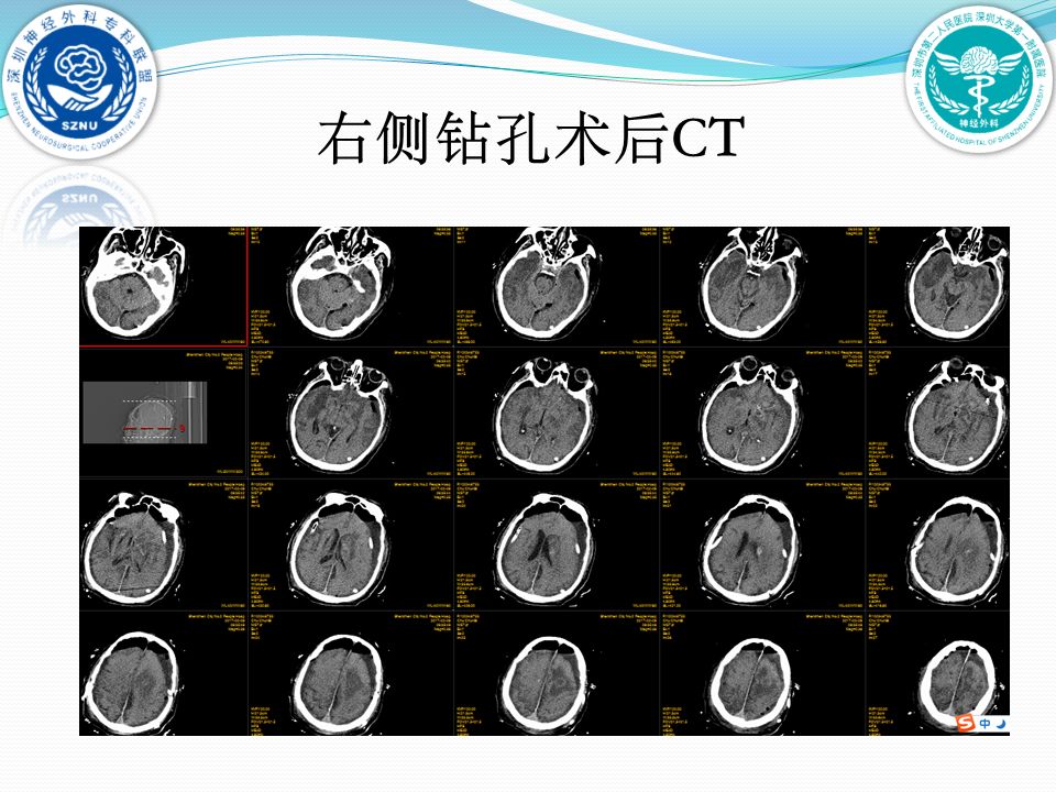 大学第一附属医院脑科中心神经重症与创伤病区黄贤键,高杰,马宇强