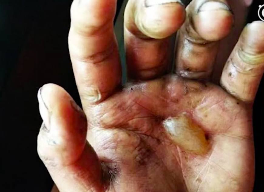 消防战士烧伤的手图片
