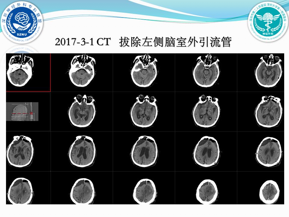 大学第一附属医院脑科中心神经重症与创伤病区黄贤键,高杰,马宇强