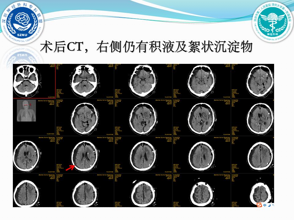 大学第一附属医院脑科中心神经重症与创伤病区黄贤键,高杰,马宇强