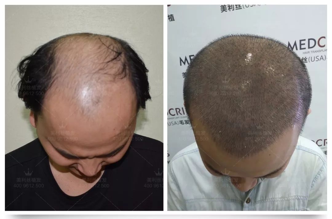 都是为拯救脱发种头发为什么有人种了两次专家揭秘
