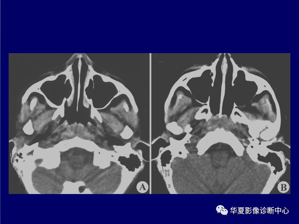 口咽ct图片