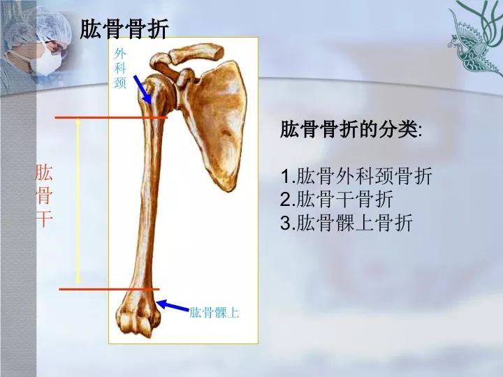 肱骨干骨折分类图片