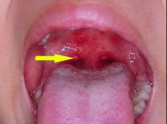 疱疹性咽峡炎手足口病图片