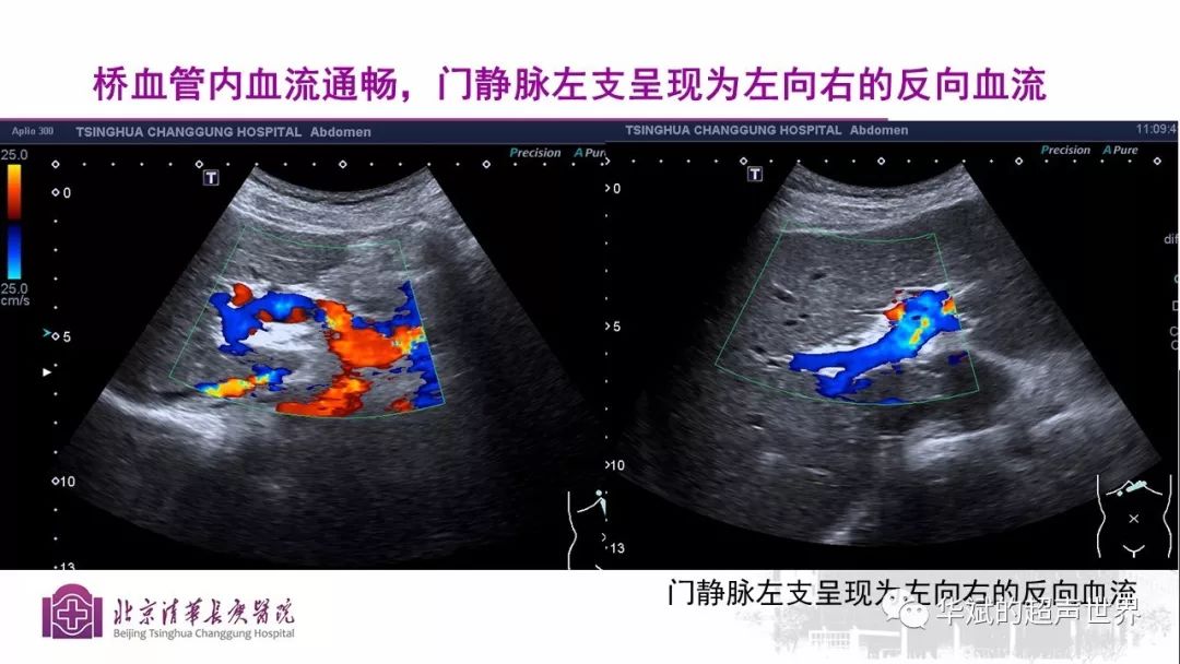 文獻和病例學習:門靜脈海綿樣變性