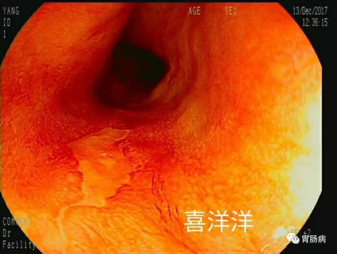 食管白斑图片图片