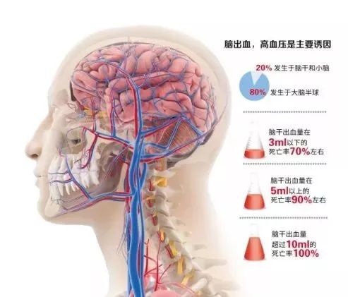 脑干出血死亡率图片