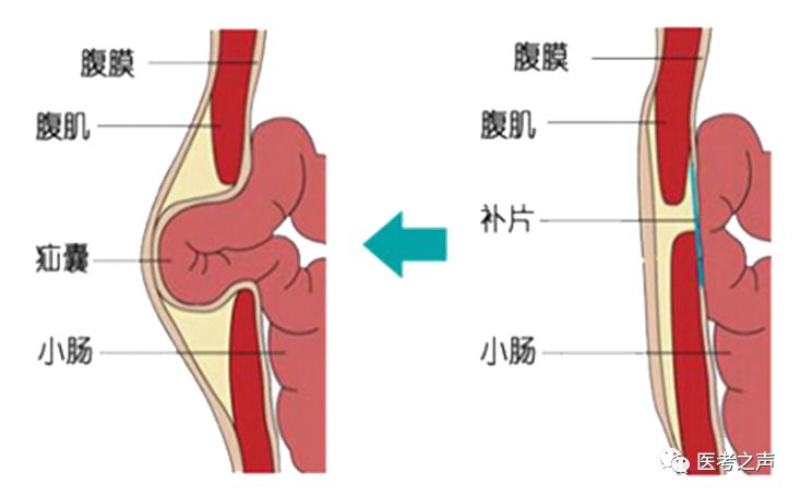 腹股沟外环口位置图片图片