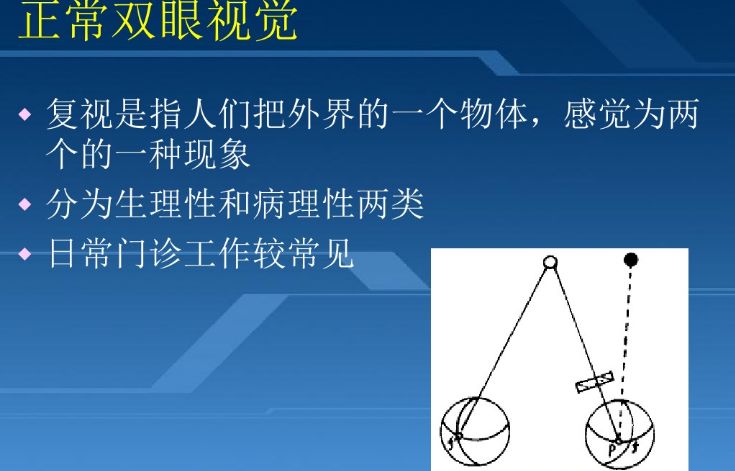 ppt病例讲解:复视诊断中的一些问题