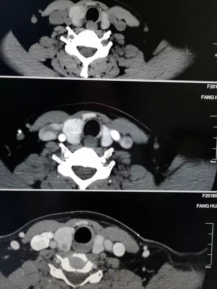 甲状腺癌ct表现图片