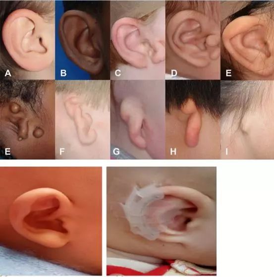 外观上主要表现为耳廓畸形甚至外耳道闭锁