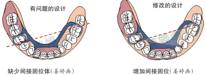 后牙支托凹预备图片图片