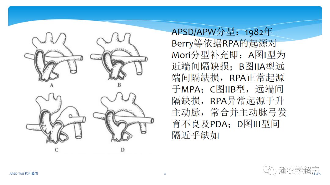 主动脉肺动脉间隔缺损图片