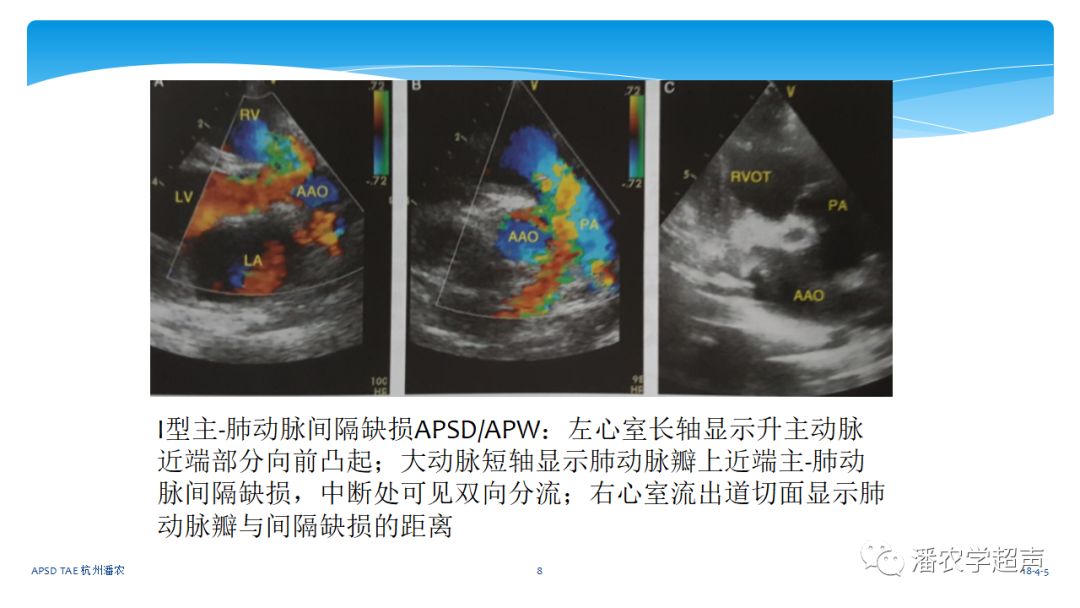 【超声微课堂】主动脉肺动脉间隔缺损经胸超声心动图诊断