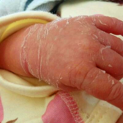2岁宝宝手指前端脱皮图片