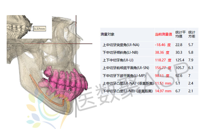 上頜通過lefort Ⅰ型截骨術截骨並去幹涉,使上頜骨上移,並以上切牙緣