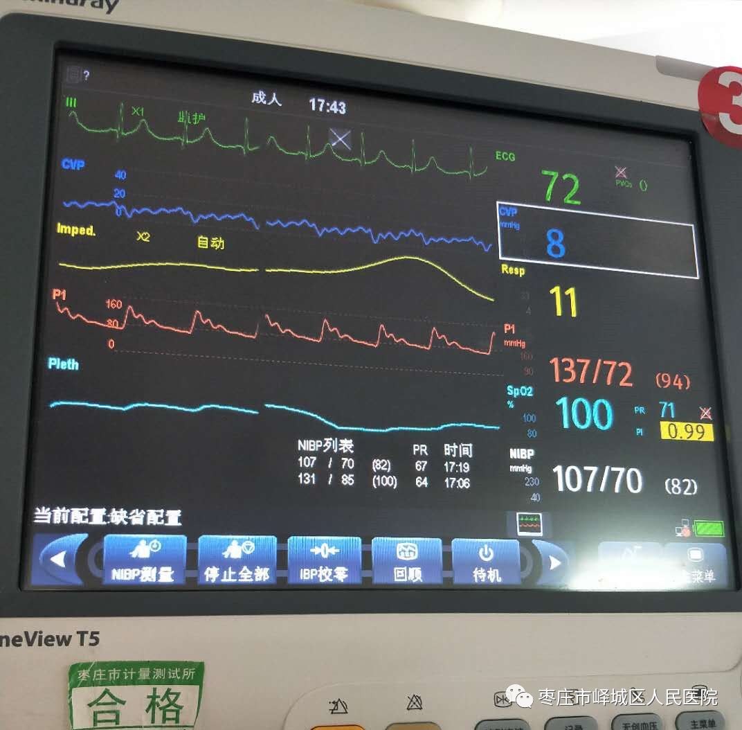 有创动脉血压监测图片