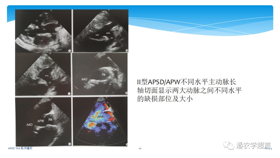 【超声微课堂】主动脉肺动脉间隔缺损经胸超声心动图诊断