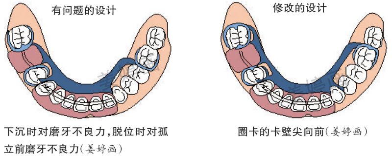 ②卡环设计不合理,卡臂尖位置不当造成固位力不足或者存在拔牙力①