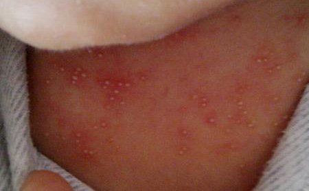 如何区分婴儿湿疹,痱子,痤疮等宝宝皮肤问题?