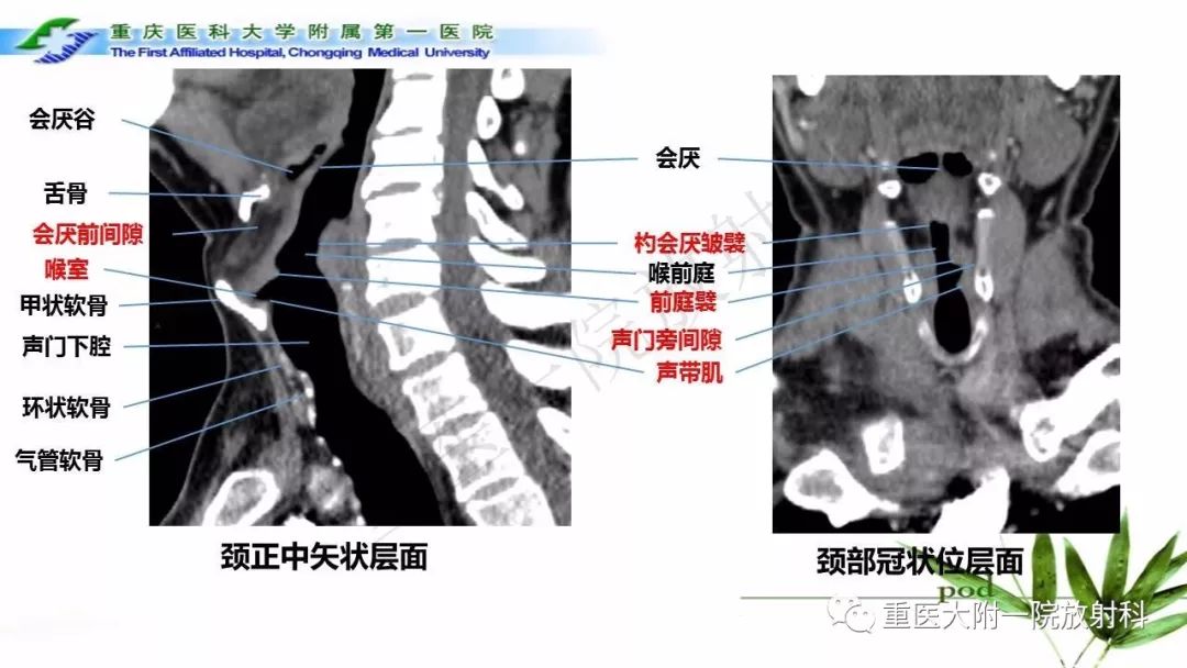 喉部断层解剖结构图解图片