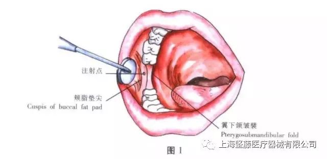 口腔颌面外科常用麻醉方法图谱