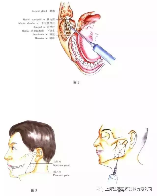 口腔颌面外科常用麻醉方法图谱