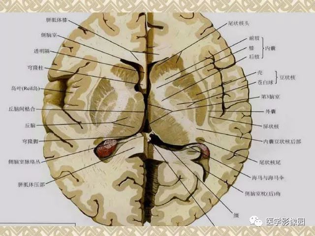 基底节对称性病变的病因和影像学特征 