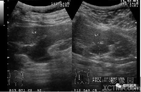 com對腎積水可用超聲向下追蹤探測,常能找到梗阻部位和梗阻原因
