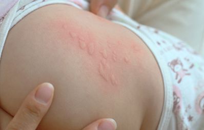 夏季儿童荨麻疹高发这样防治最有效