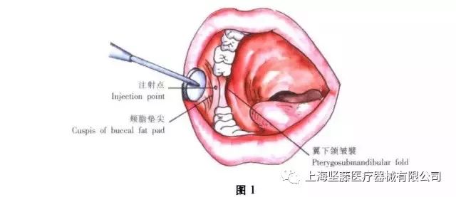 牙齿打麻药的位置图图片