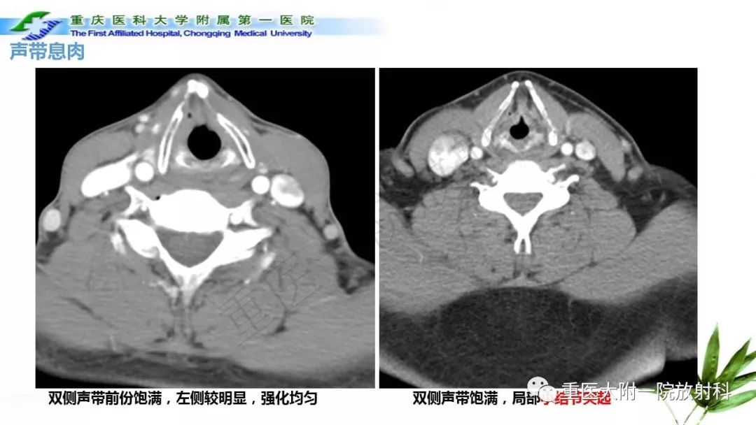 喉部MRI断层解剖图片