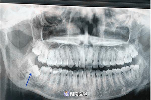 智齿长到上颌窦ct图图片