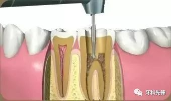 根管治療:你的牙齒可能不需要拔