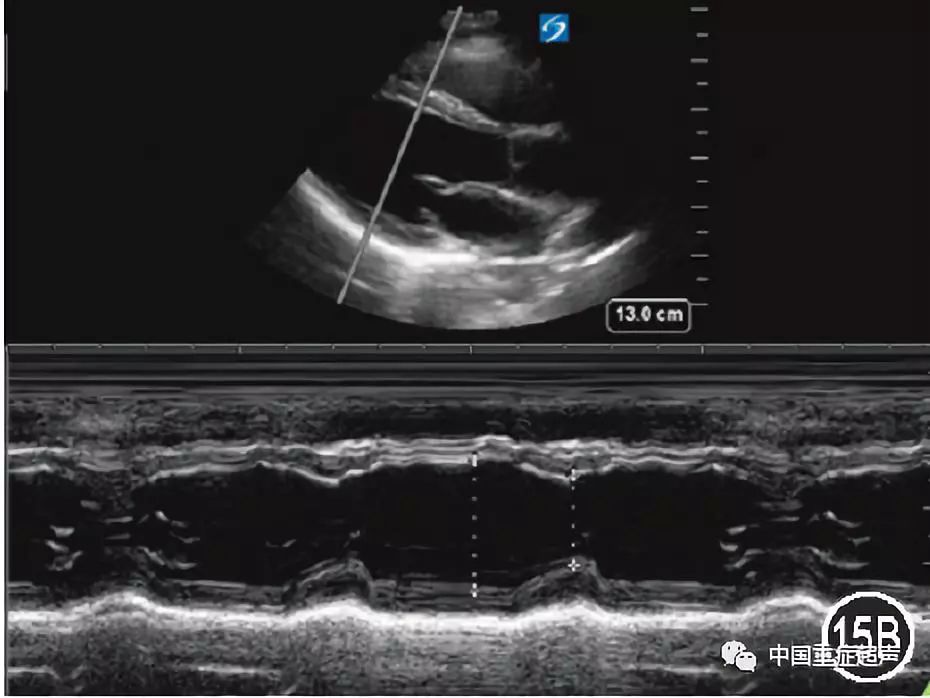 图15 胸骨旁长轴切面超声图15a 室间隔厚度测量超声图15b 左心室射血