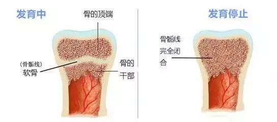 纳米骨增高图片