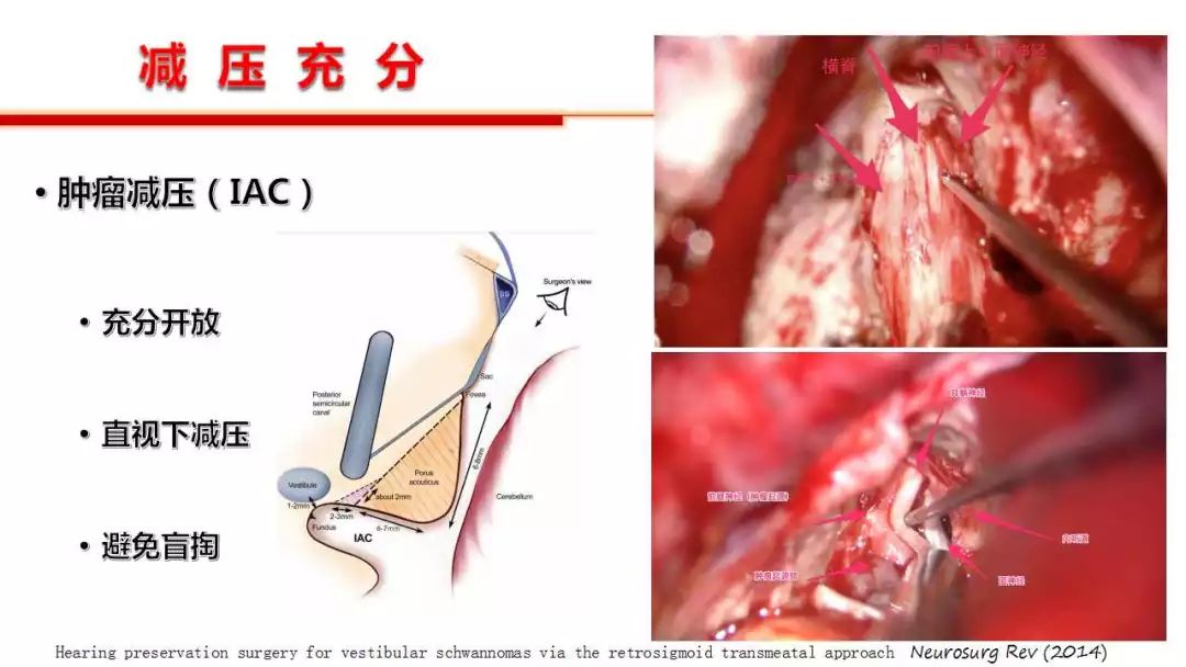 巴氏腺囊肿造口术步骤图片