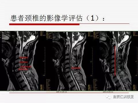 頸椎運動治療科普您需要了解不一樣的運動治療