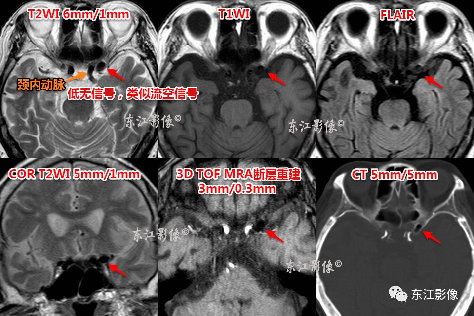 容易誤認為異常的靜脈竇,淺靜脈1)橫竇,乙狀竇流空信號消失,mimc