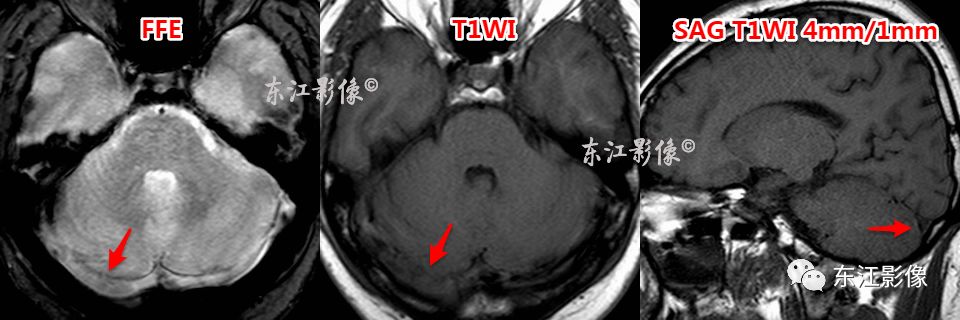 左侧乙状窦t2wi,flair高信号