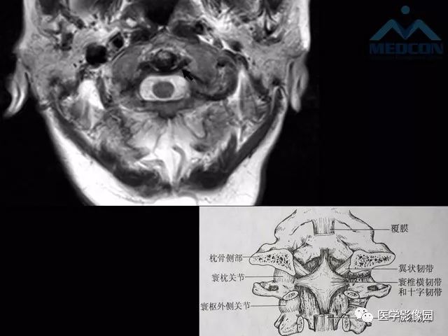 寰樞關節脫位的影像診斷