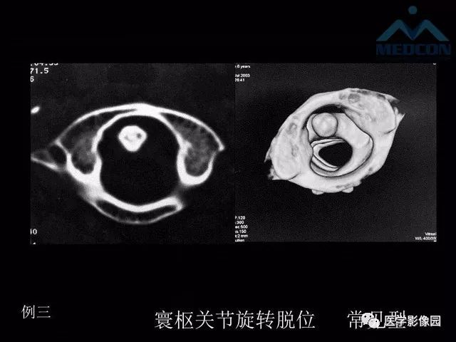 环杓关节脱位ct图片