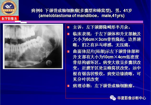 造釉细胞瘤ct图片图片