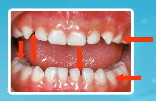 乳牙的形态解剖特点1乳牙易患龋的因素由于乳牙的血液循环比较好,根管