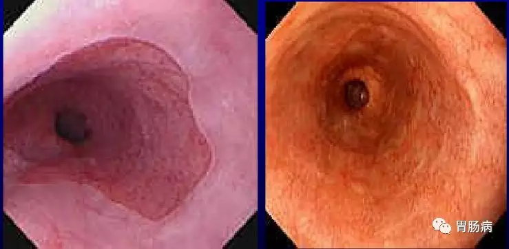 巴雷特食管症状图片图片