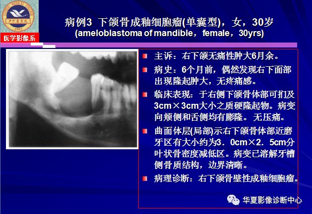 口腔成釉细胞瘤ct图片图片