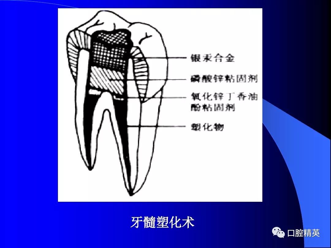 牙髓及根尖周病的治疗