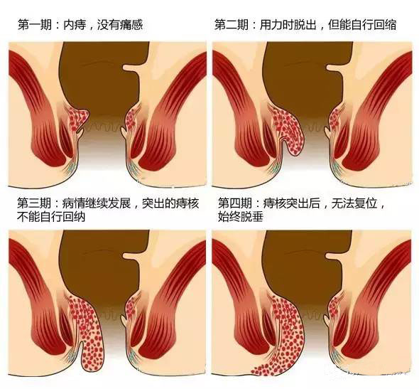 內痔通常分為Ⅰ,Ⅱ,Ⅲ期.