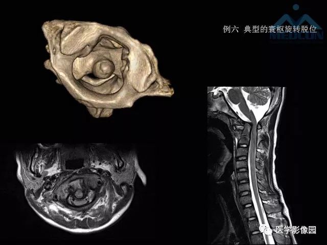 环杓关节脱位ct图片